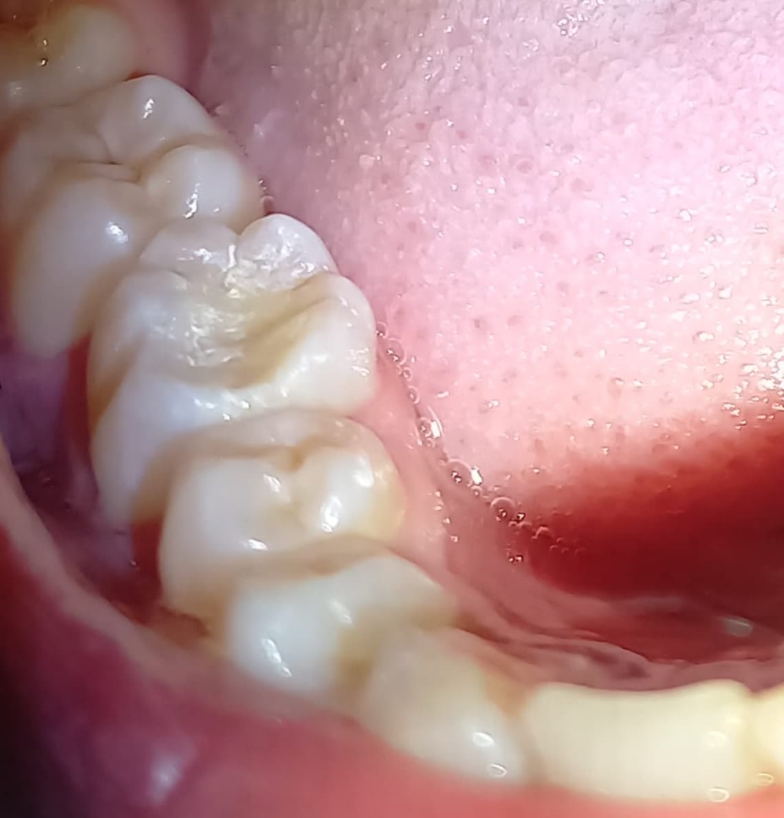 After Treatment